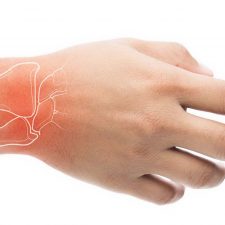 New Approach for Carpal Tunnel Release