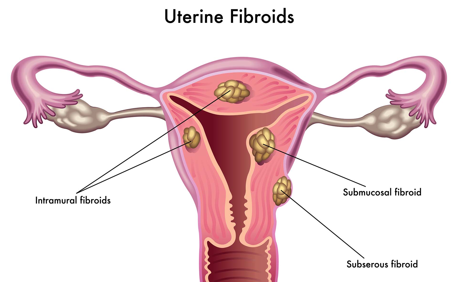 Treatment Of Uterine Fibroids